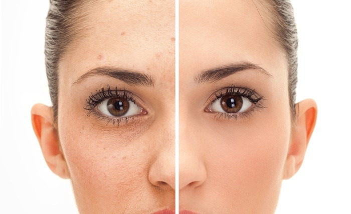 Fractional CO2 Laser before and after