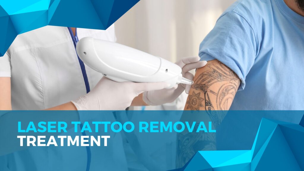 Laser Tattoo Removal in Islamabad