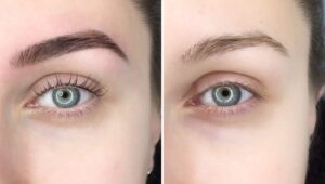 Eyebrow tattoo removal / tattoo removal before and after