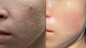 Fractional CO2 lasers before and after