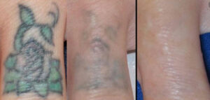 Laser Tattoo Removal