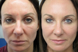 PRP Vampire Facial before and after