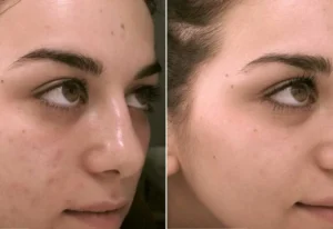carbon peel laser before and after