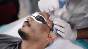 carbon peel laser for men

