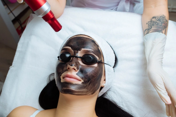 Carbon peel laser benefits, carbon peel laser cost, carbon peel laser before and after
