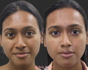 Laugh lines fillers before and after