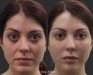 Laugh lines fillers before and after