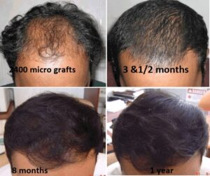 hair transplant before and after