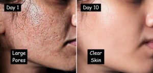 open pores treatment before and after