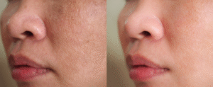 best open pores treatment before and after 