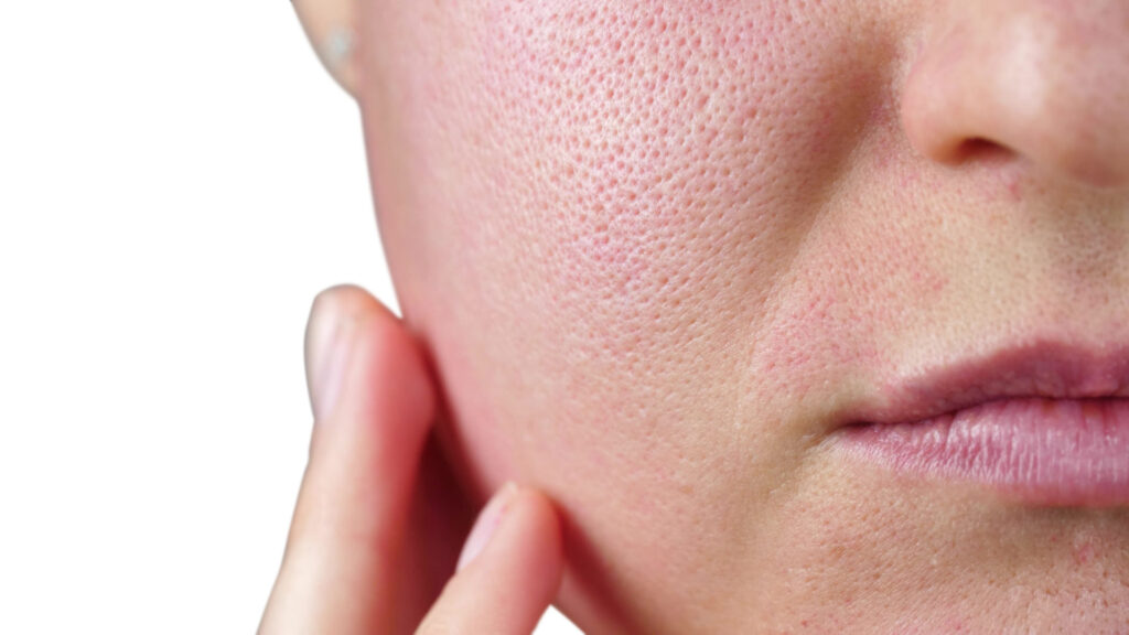 Best open pores treatment in Islamabad