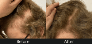 Best PRP hair treatment before and after