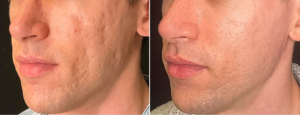 exosomes for skin / exosomes therapy before and after
