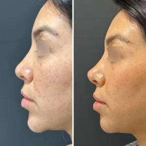Chin filler dissolving before and after
