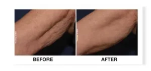 profhilo results / profhilo before and after / profhilo for arms
