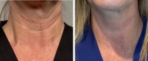 profhilo results / profhilo before and after / profhilo for neck
