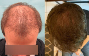 exosomes for hair loss / exosomes therapy before and after