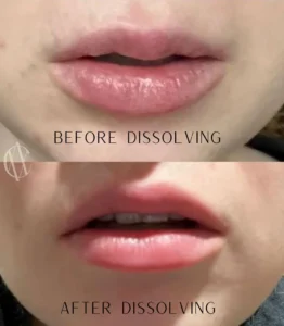 Lip filler dissolving before and after