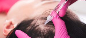 Best PRP Hair treatment before and after