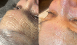 radio frequency facial / radio frequency before and after