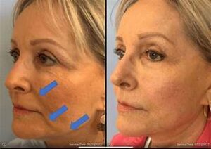 face thread lift before and after
