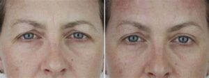 eyes thread lift before and after / eyebrows thread lift before and after 