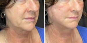 face thread lift before and after / neck thread lift before and after