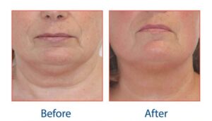 radio frequency for jowls / radio frequency facial before and after