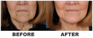 radio frequency for jowls / radio frequency facial before and after