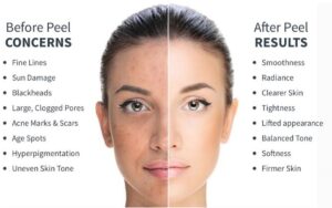 Best Chemical Peel in Islamabad / Chemical Peel before and after
