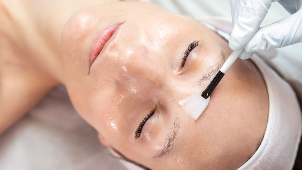 Best Chemical Peel in Islamabad