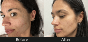 Best Chemical Peel in Islamabad / Chemical Peel before and after